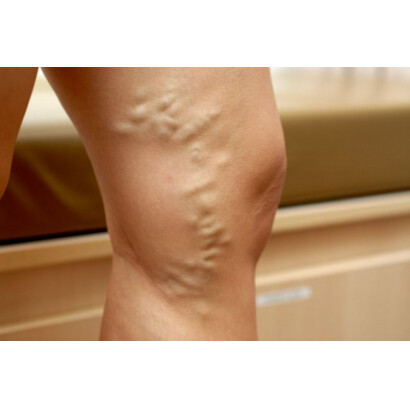 Utrujene in težke noge ? 